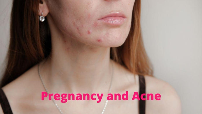 Pregnancy and Acne
